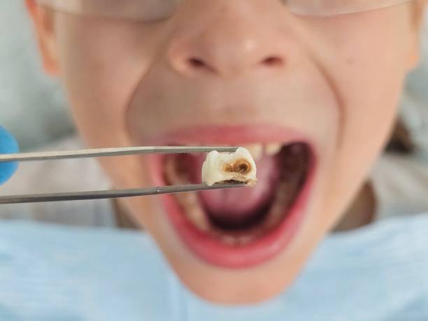 Best Emergency Wisdom Teeth Removal in Bangor, WI
